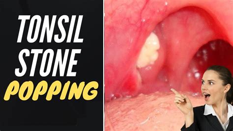 Tonsil Stone Removal Popping Tonsil Stones Youtube