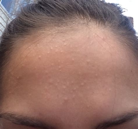 Small Bumps On My Forehead General Acne Discussion Acne Org Community