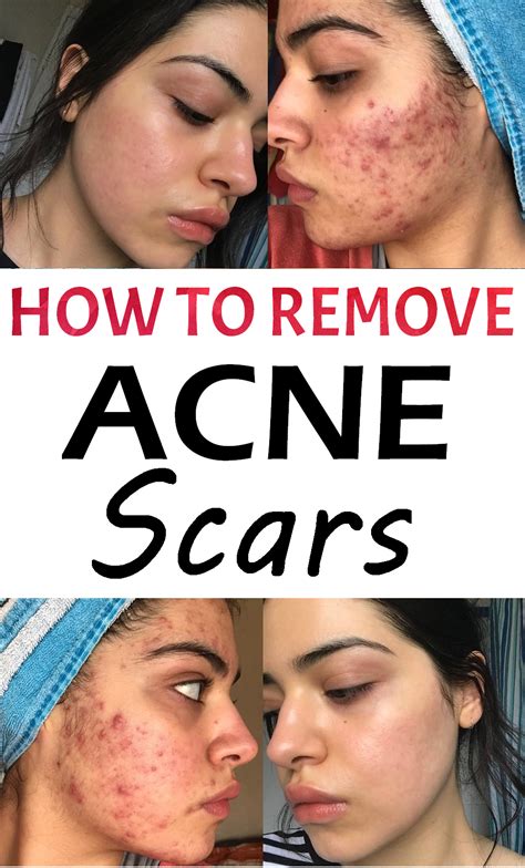 Really Bad Acne Scars On Forehead Shearlingwomenbestquality