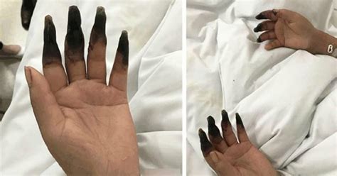 Woman Has Her 8 Fingers Turned Black After Cleaning The House