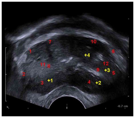 Prostate Biopsy Pain Ultrasound