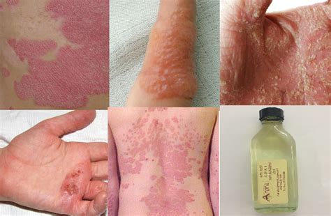 Eczema Or Atopic Dermatitis And Psoriasis Are Both Fairly Common