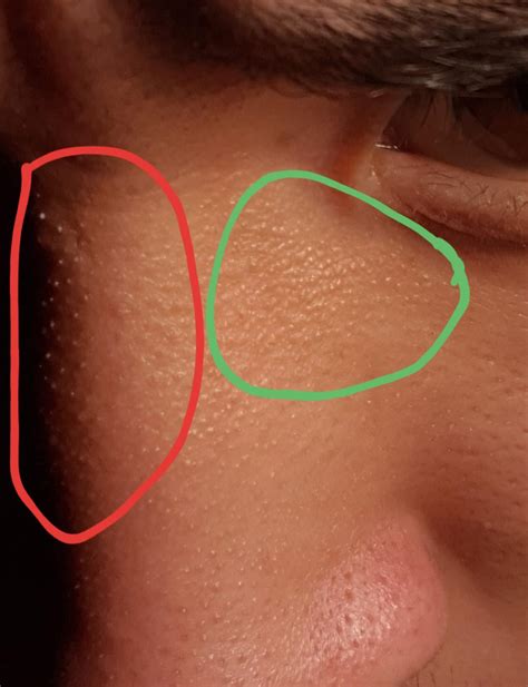 What Could These Little Bumps Be And How Should I Go Treating Them R