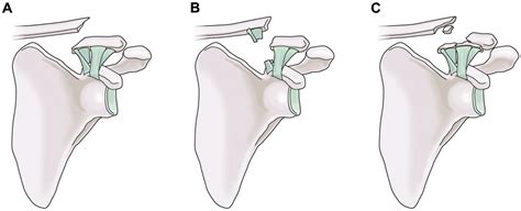 Residual Coracoclavicular Separation After Plate Fixation For Distal