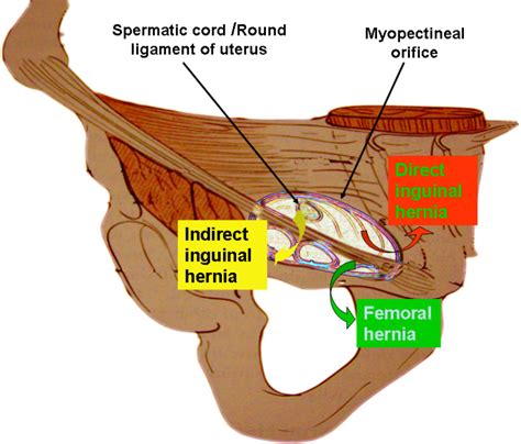 Anatomy Essentials For Laparoscopic Inguinal Hernia Repair Yang