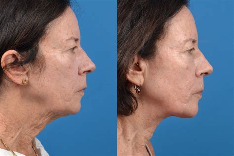 Patient 122406559 Profile Neck Lift Before And After Photos Clevens