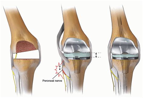 Valgus Knee Deformity Musculoskeletal Key