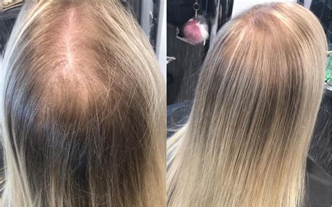 Thinning Hair From Chemo Hair Styles What Are The Best Hairstyles For