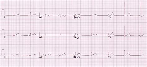 Posterior Myocardial Infarction Litfl Ecg Library Diagnosis