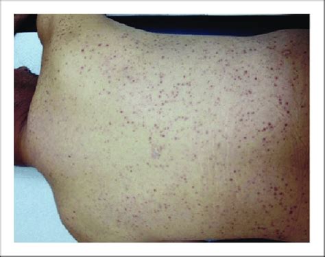 Diffuse Erythematosus Maculopapular Lesions And Occasional Pustules At