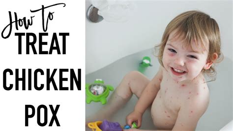 How To Treat Chicken Pox Chicken Pox Remedies Youtube
