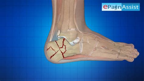 Surgical Treatment For Calcaneus Fracture Or Broken Heel Its Types Youtube