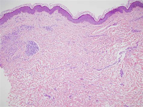 Interstitial Granulomatous Dermatitis With Granuloma Annulare Like