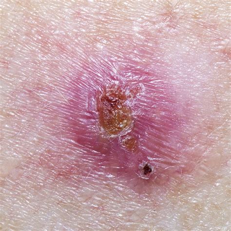 Skin Cancer Lesions Hot Sex Picture