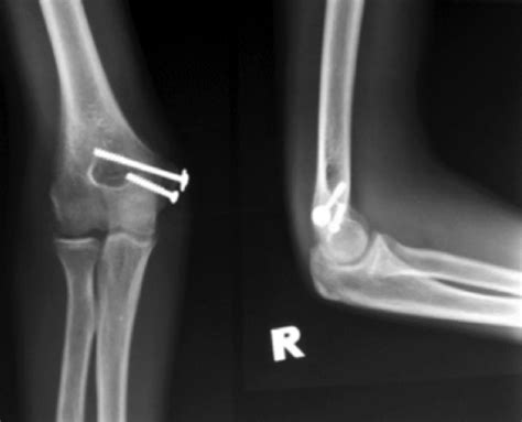 Epicondyle Medial Epicondylar Fractures Of The Humerus