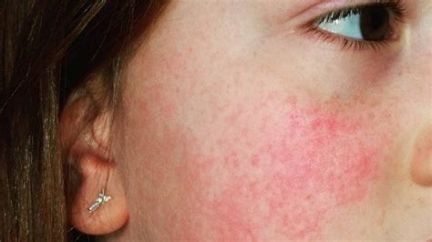 ‘slapped Cheek Syndrome A Common Rash In Kids More