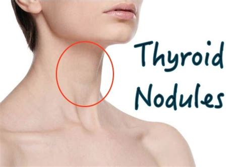Pin On Thyroid