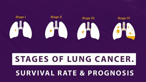 stages of lung cancer survival rate and prognosis macs clinic