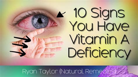 Common Signs Of Vitamin A Deficiency Youtube