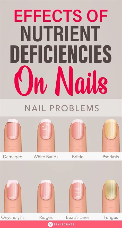 Effects Of Nutrient Deficiency On The Nails What Do They Indicate About Your Health Nail