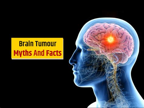 World Brain Tumour Day 2021 7 Myths And Facts About Brain Tumour
