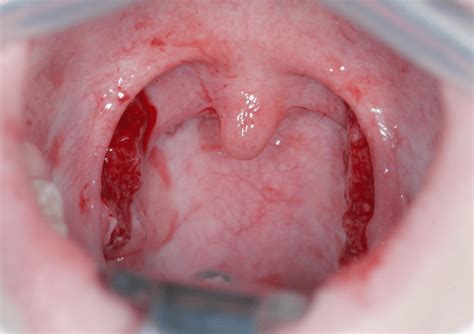 Intraoperative Image After Partial Removal Of The Tonsils On Both Sides