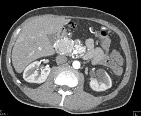 Neuroendocrine Tumor In The Pancreas With Vascular Liver Metastases And