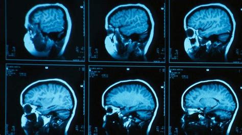 Researchers Brain Abnormalities Found In 4 5 Year Olds With Adhd