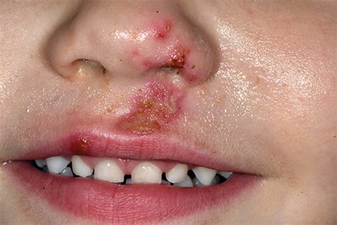Facial Ulcers In Children Gponline