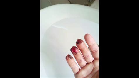Finger Wounds Healing Youtube