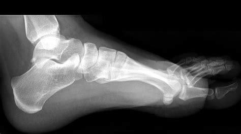 Less dense tissues appear in shades of gray. foot x ray - Lizzy
