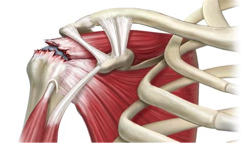 Tendinitis Y Rotura Del Manguito Rotador Causas Y Tratamientos My Xxx