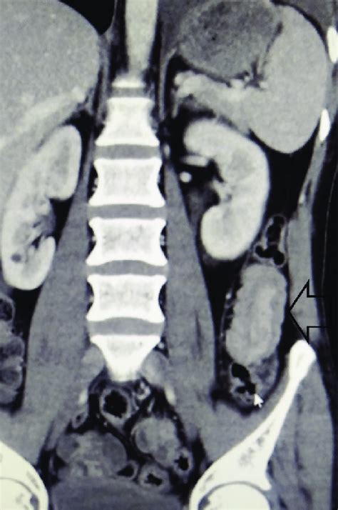 Tomographic View Of Small Bowel Intussusception Arrow Download