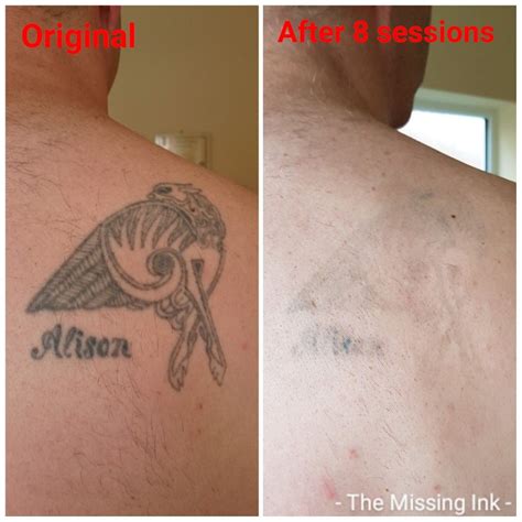 Back Tattoo Back Tattoo Laser Tattoo Laser Tattoo Removal
