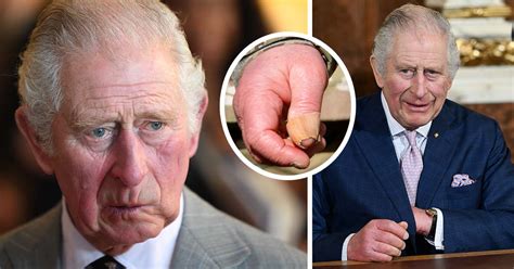 King Charles Sausage Fingers Doctor Claims Theyve Gotten Worse