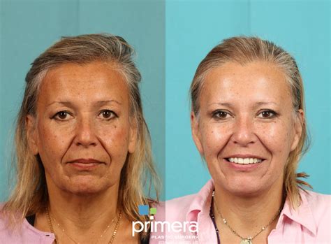 Mini Facelift Before And After Pictures Case 770 Orlando Florida