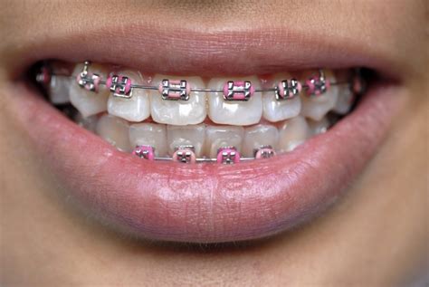 Vibrant Coloured Braces In Langley Personalize Your Smile