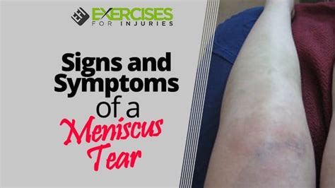 Signs And Symptoms Of A Meniscus Tear Exercises For Injuries