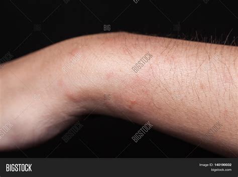 Dog Bite Wound Scar Image And Photo Free Trial Bigstock