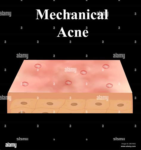 Cyst Acne Acne On The Skin Of A Cyst Dermatological And Cosmetic