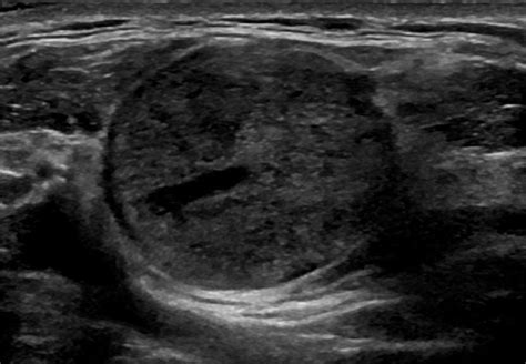 An Ultrasound Image Of The Well Circumscribed 22 × 22 × 25 Mm Round