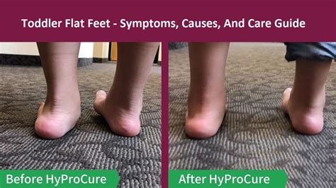 Toddler Flat Feet Symptoms Causes And Care Guide
