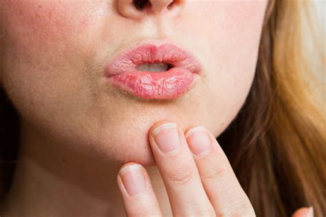 Lip Burn Causes And Treatment Truehealthmag