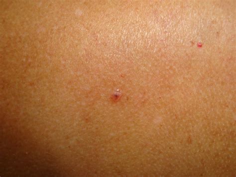 Signs Of Skin Cancer On Back