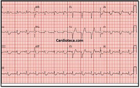 Patient:innen mit solchen ekgs und passender symptomatik brauchen potentiell dringend eine herzkatheteruntersuchung. Curso ECG: IAM anterior Patrón de De Winter