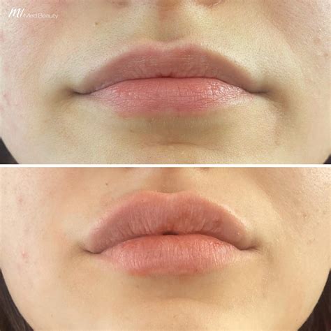 Beforeafter M1 Med Beauty Australia