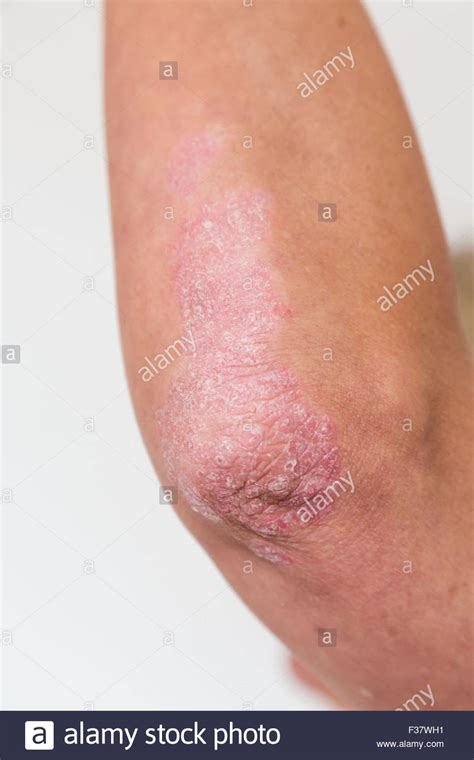 Psoriasis Skin Dermatology Hi Res Stock Photography And Images Alamy