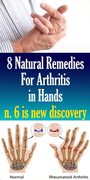 8 Natural Remedies For Arthritis In Hands Nutrition Health