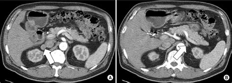 A B Abdominopelvic Computed Tomography Showed Bilateral Adrenal