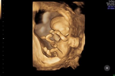 How much is a 3d ultrasound uk. 12 week 3d ultrasound--- what do you think? - BabyCenter